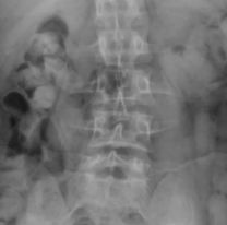 Tres ciudadanos bolivianos quedaron detenidos por ingerir 235 cápsulas con cocaína