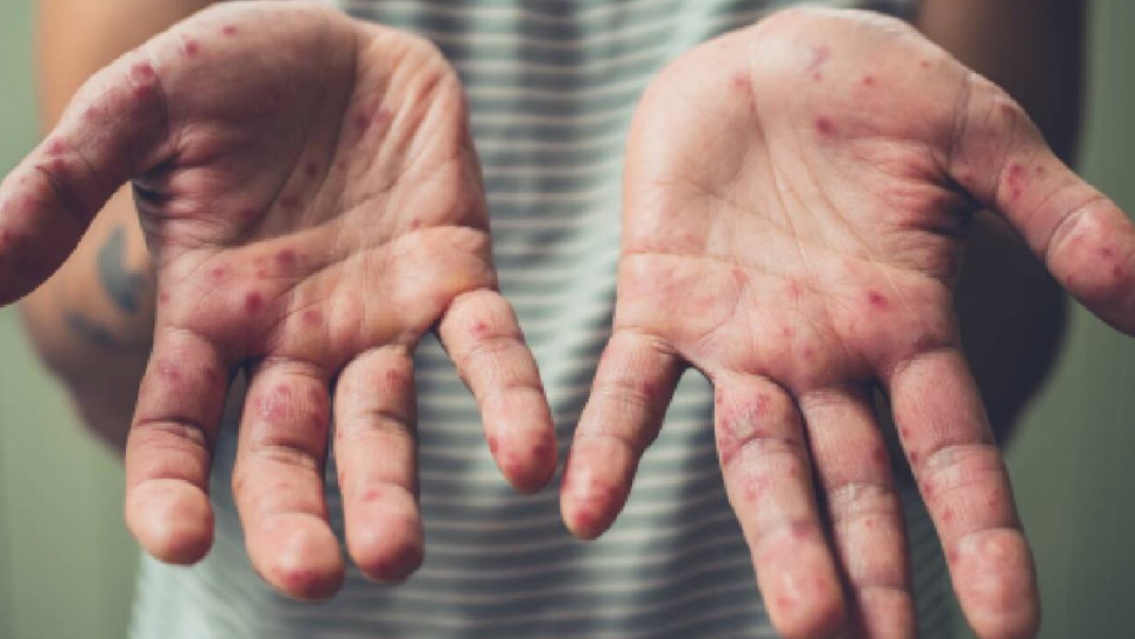 Refuerzan controles en Jujuy por brote de sarampión en Bolivia