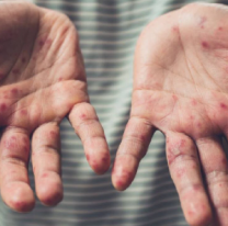 Refuerzan controles en Jujuy por brote de sarampión en Bolivia