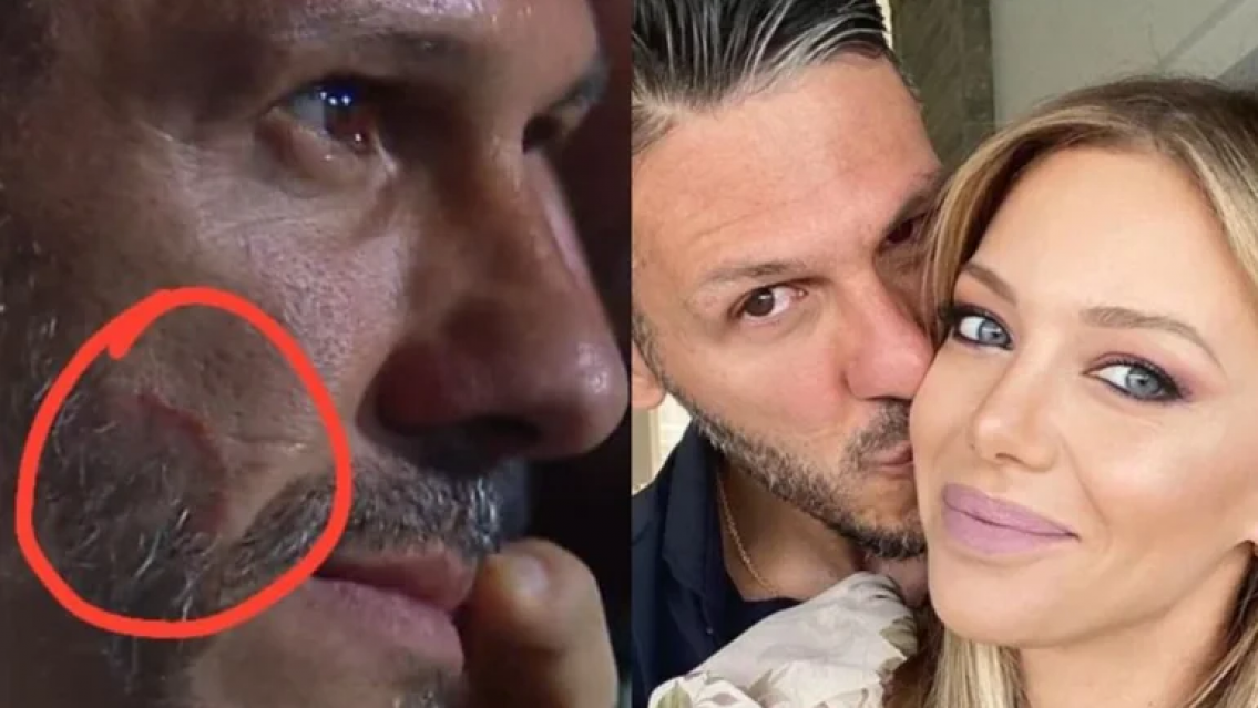 El d�a que Demichelis apareci� con una mordida en la cara, �qui�n se la hizo?