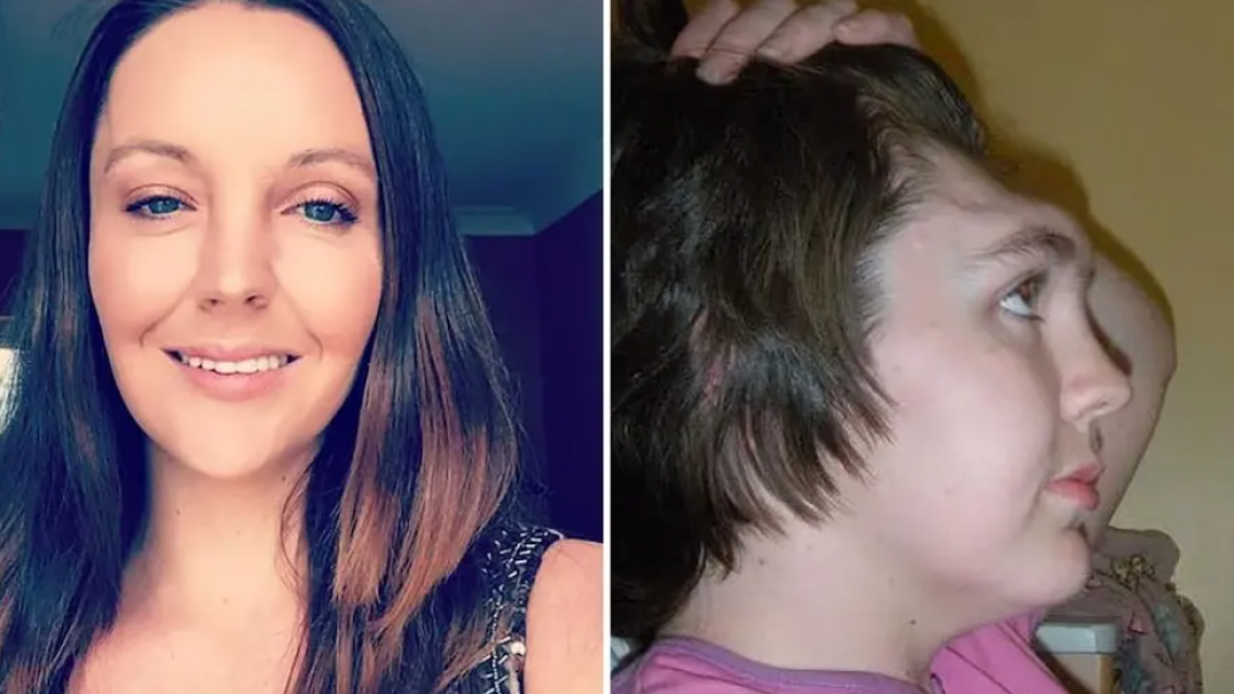 Mujer perdi� la frente en accidente por viajar con los pies sobre el tablero