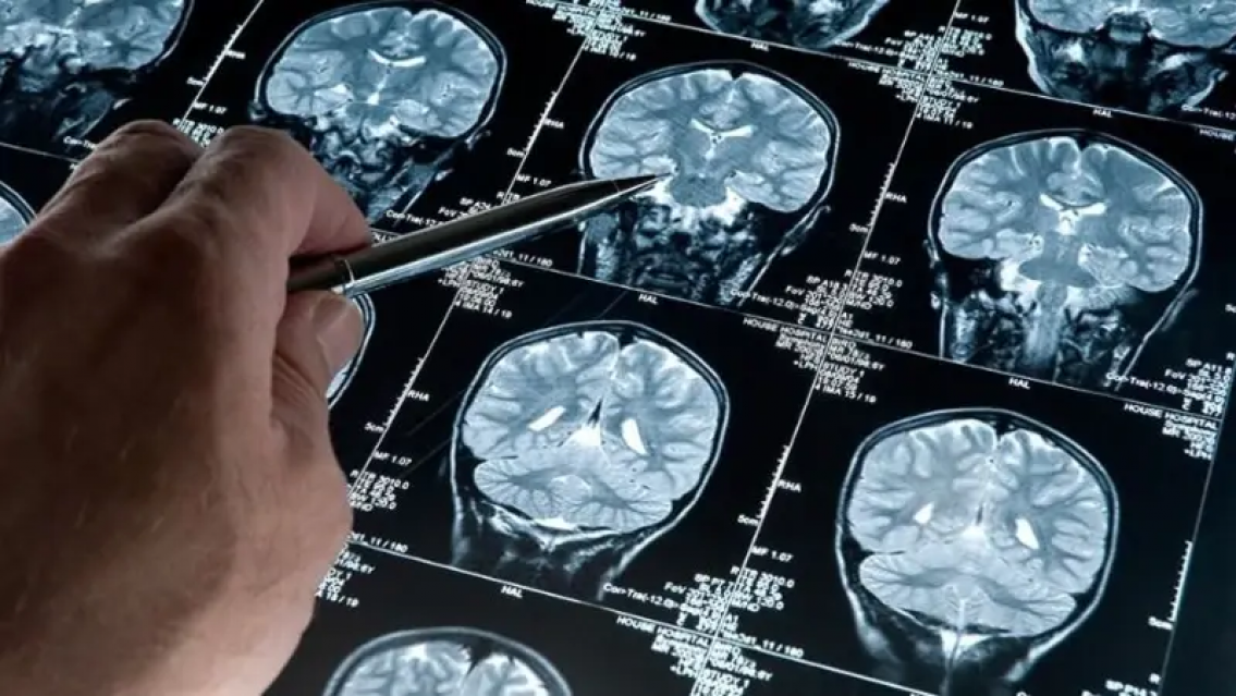 Gran avance sobre el Alzheimer: de la mano de científicos argentinos