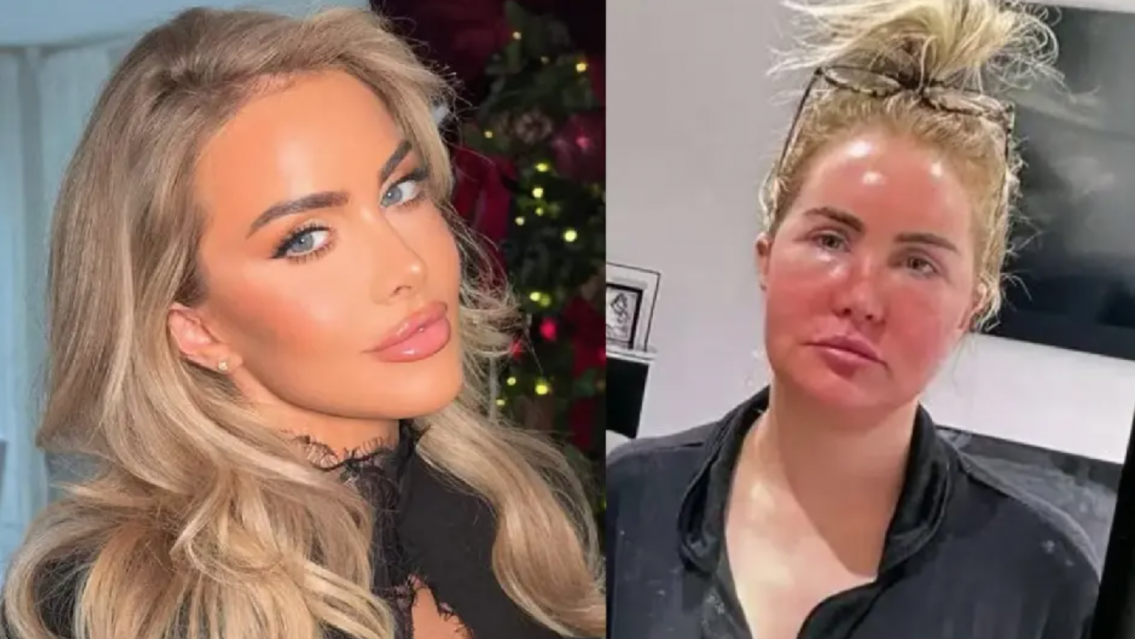 Se hizo una cirugía estética y en el quirófano encontraron algo asqueroso dentro de su cara