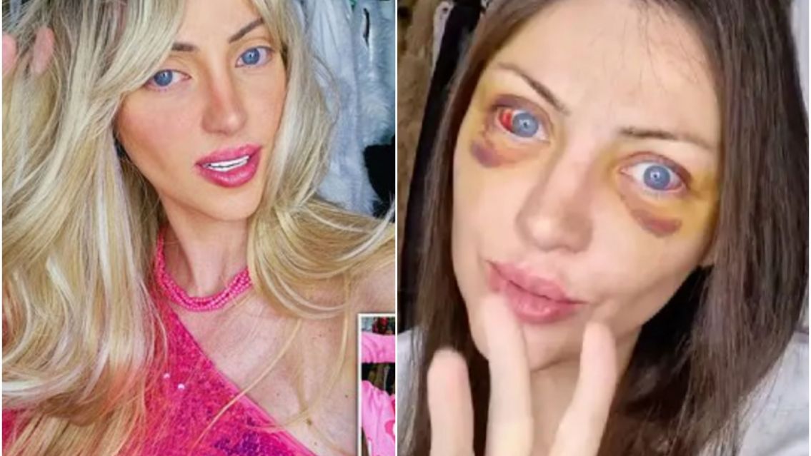 Conmoci�n por la muerte de una influencer que se transform� en "Barbie humana"