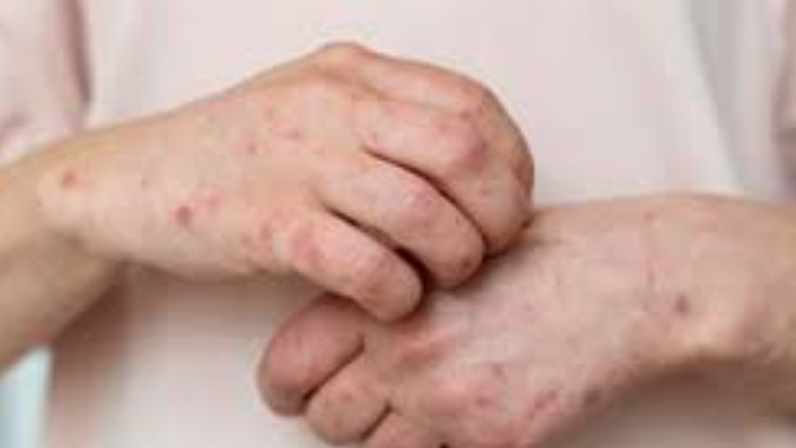 Sarampión: un grupo de contagiados recorrió Jujuy y activó controles en la región