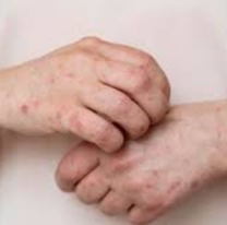 Sarampi&oacute;n: un grupo de contagiados recorri&oacute; Jujuy y activ&oacute; controles en la regi&oacute;n