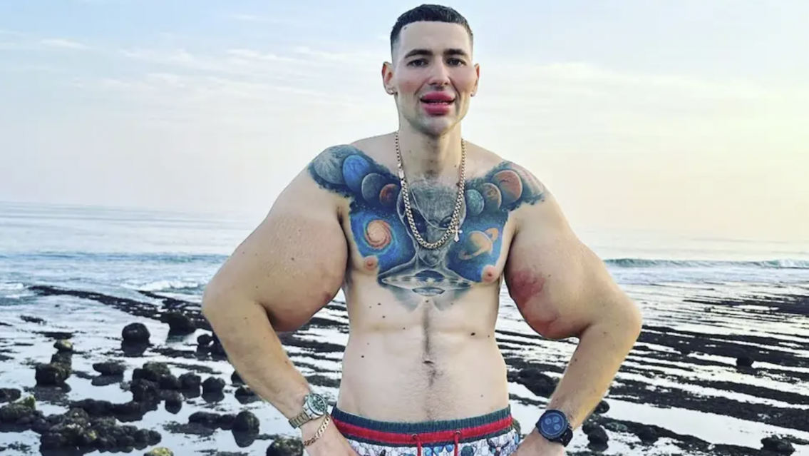 La angustia del "Popeye humano" porque podría perder los dos brazos