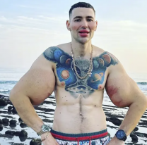 La angustia del "Popeye humano" porque podría perder los dos brazos