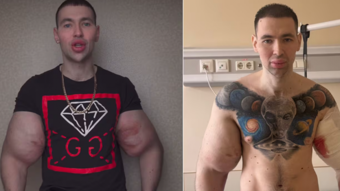 Se puso vaselina en los b�ceps para parecerse a "Popeye"