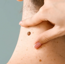 Cómo actúa Vaccimel, la nueva vacuna argentina contra el cáncer de piel