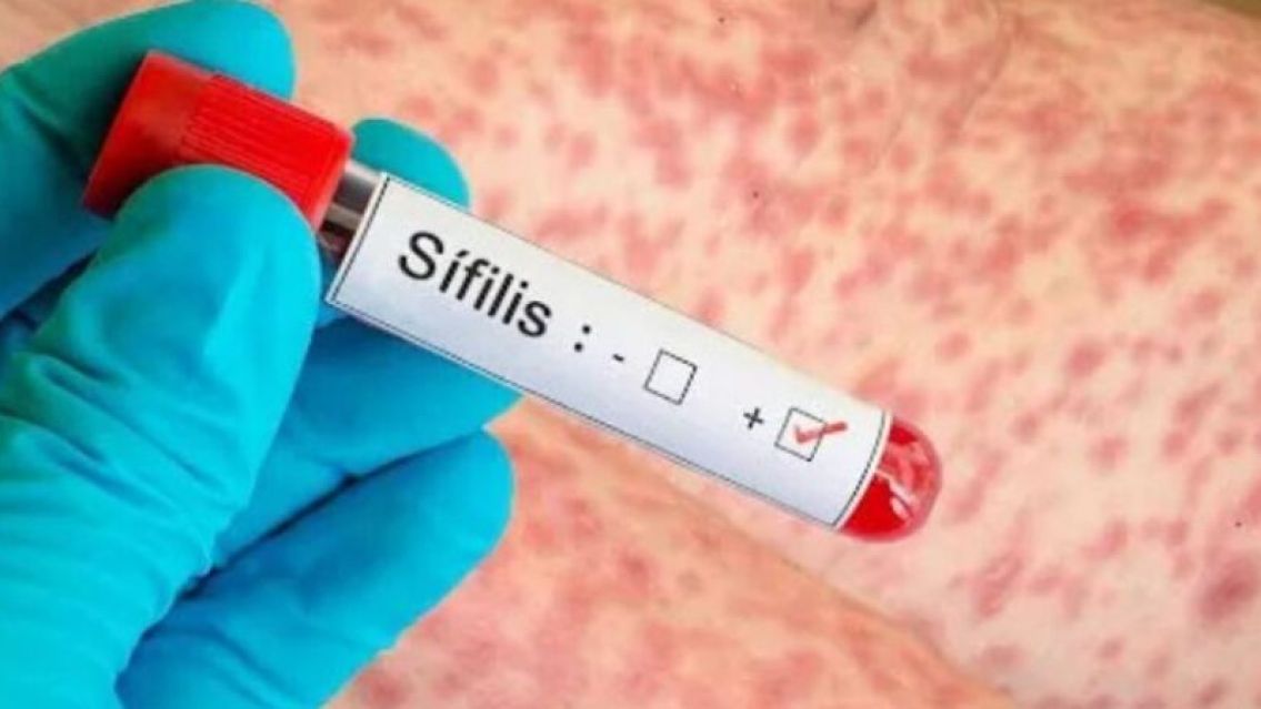 Sífilis: qué es, cómo se contagia y por qué los jujeños tienen que prestar atención
