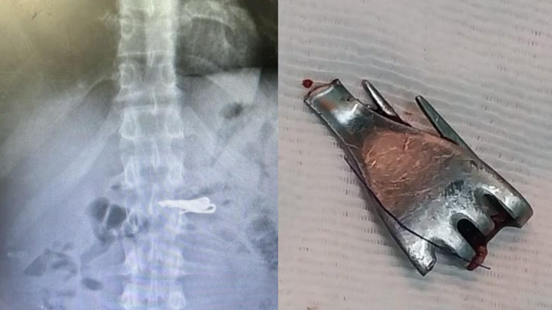 Un preso de alto perfil se tragó un tenedor en la cárcel