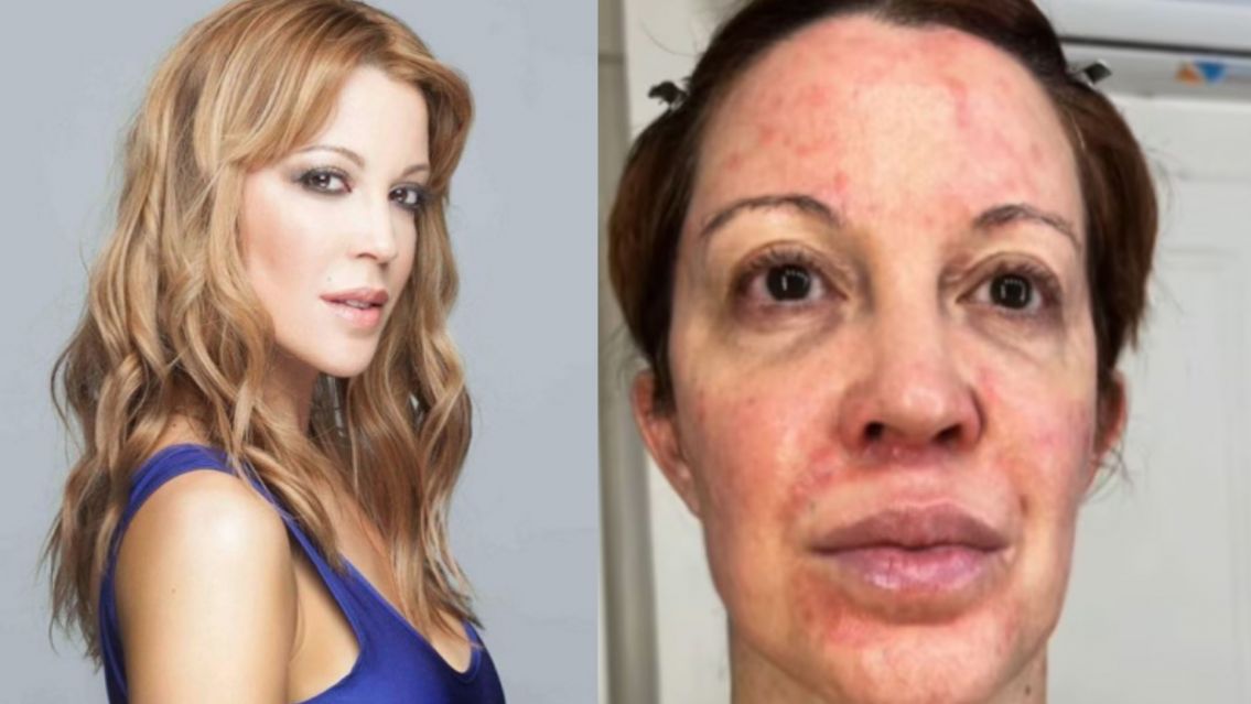 Miriam Lanzoni rompi� el silencio y mostr� su lucha contra una dura enfermedad de la piel