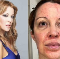 Miriam Lanzoni rompió el silencio y mostró su lucha contra una dura enfermedad de la piel