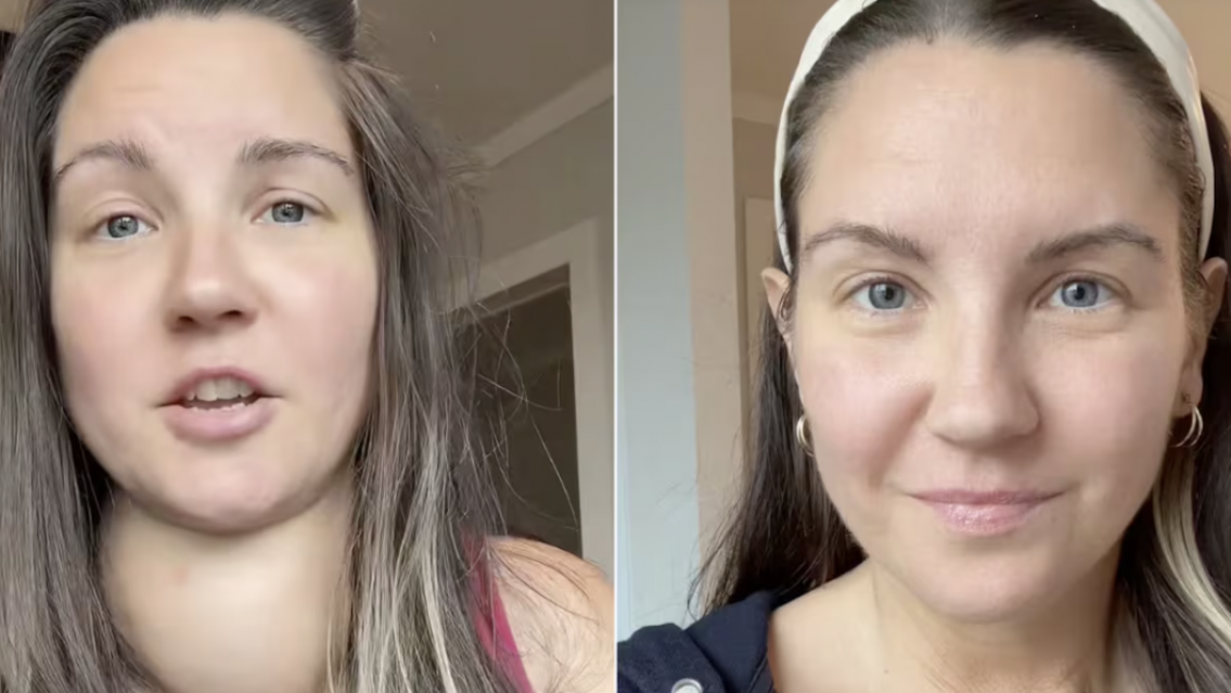 Tuvo por a�os "el cuello salido" por negligencia m�dica, luch� para que la operaran