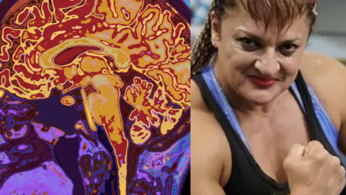 ACV isquémico en Jujuy: todo sobre la medicación para hacerle frente