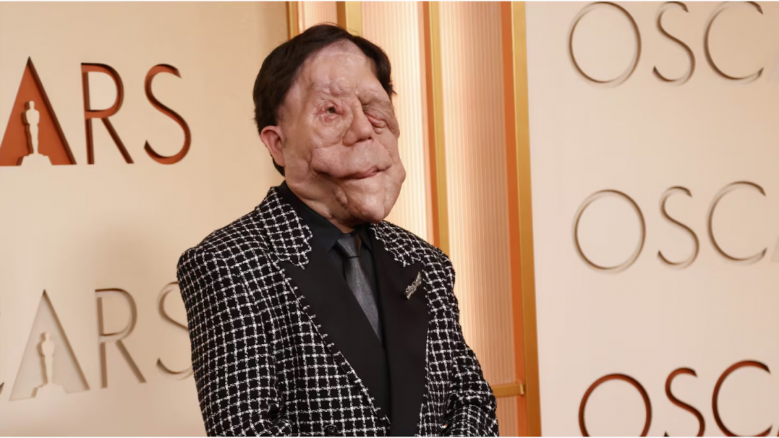 Adam Pearson, el actor que se sometió a 30 cirugías y participó en los premios Oscar