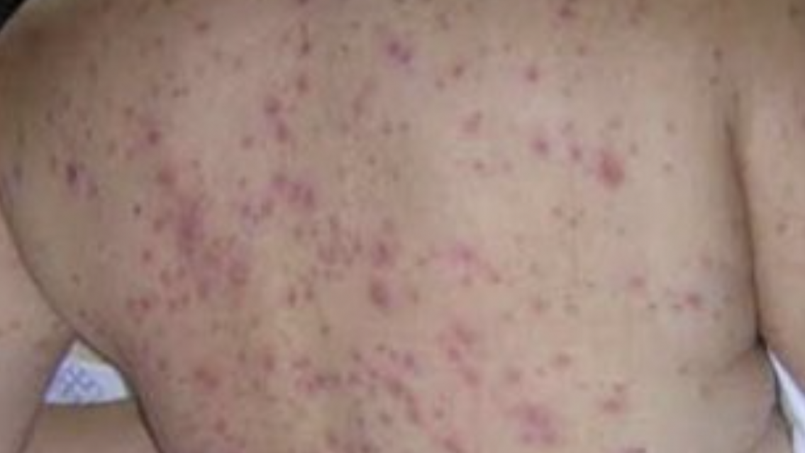 Jujuy ya supera los 30 casos de chikungunya y hay otros 14 sospechosos