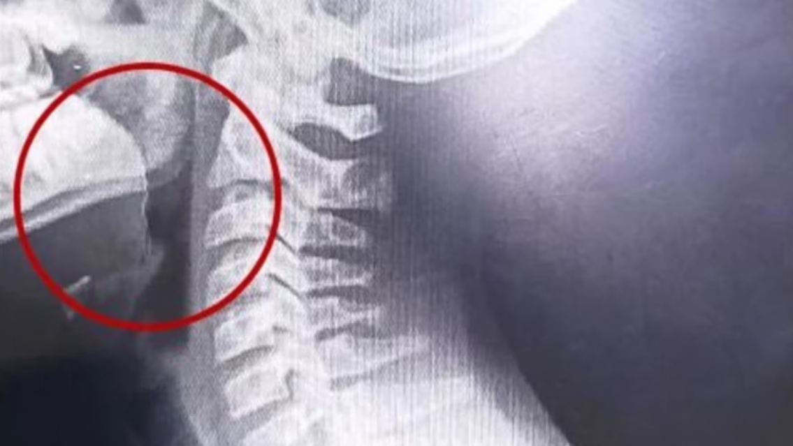 Tiene 14 años, comió una galletita y empezó a escupir sangre