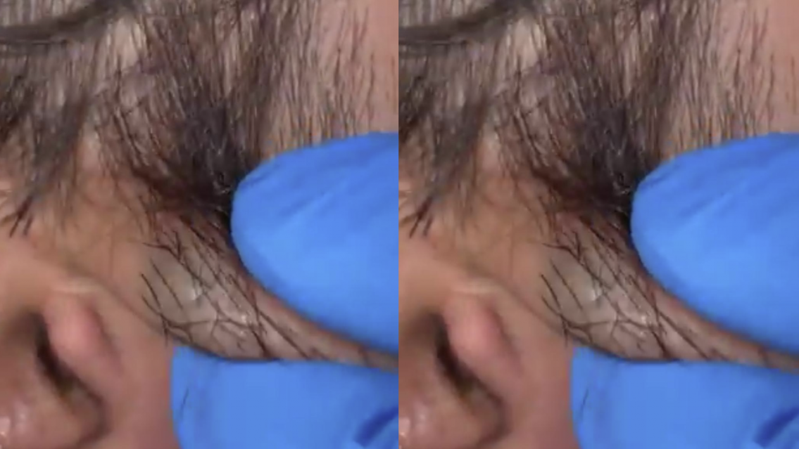 "M�s que un pelo encarnado": esto le sacaron a un hombre que ten�a "dolor de cabeza"