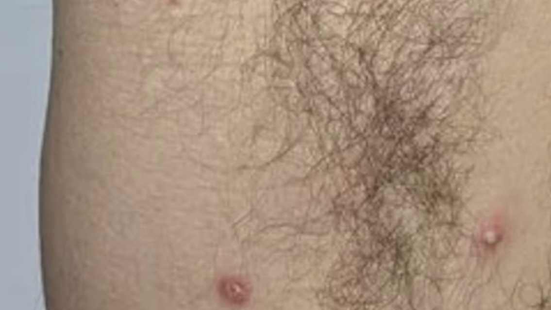 Rara "enfermedad de la lluvia", se transmite por vía sexual y ya atacó a varios
