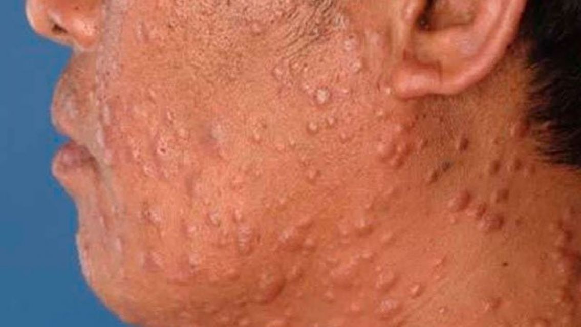 La provincia argentina que registr� 36 casos de Lepra en 2018