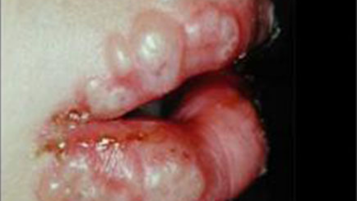 Sífilis: la enfermedad sexual que aumenta en Salta, especialmente en el norte