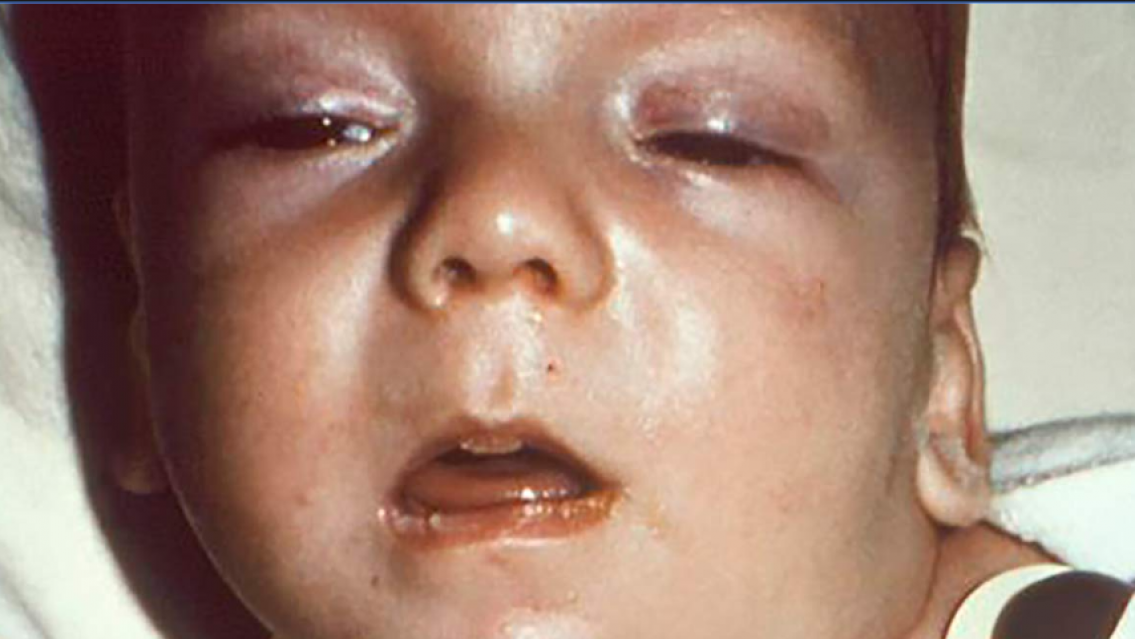 �Qu� es el botulismo, cu�les son las causas y c�mo prevenirlo?