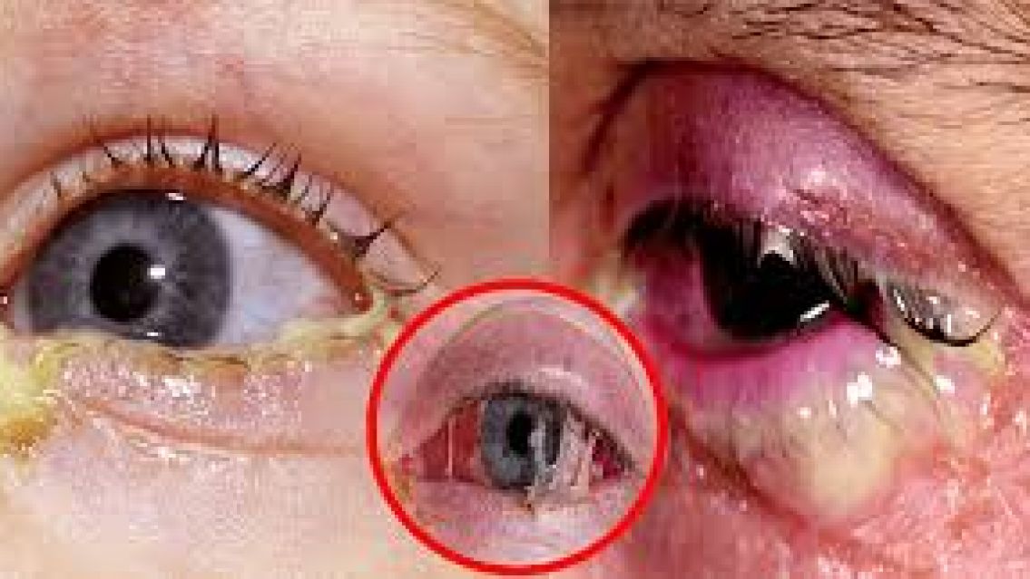 La enfermedad de transmisión sexual que preocupa a todos: parece conjuntivitis, pero no