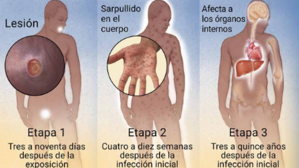 Estos son los s�ntomas de la s�filis