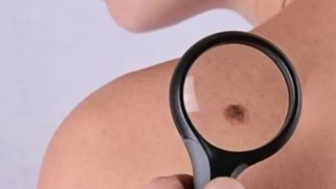 El significado de tus lunares según su ubicación en el cuerpo