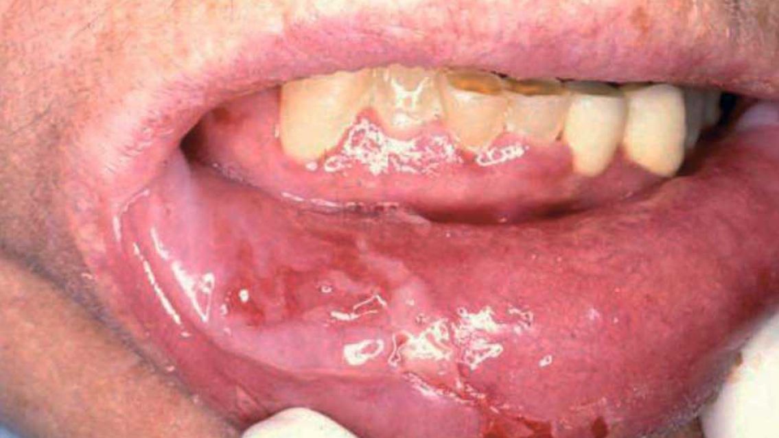 Preocupaci�n por enfermedad de transmisi�n sexual: "Es mucho m�s f�cil de transmitir que el VIH"