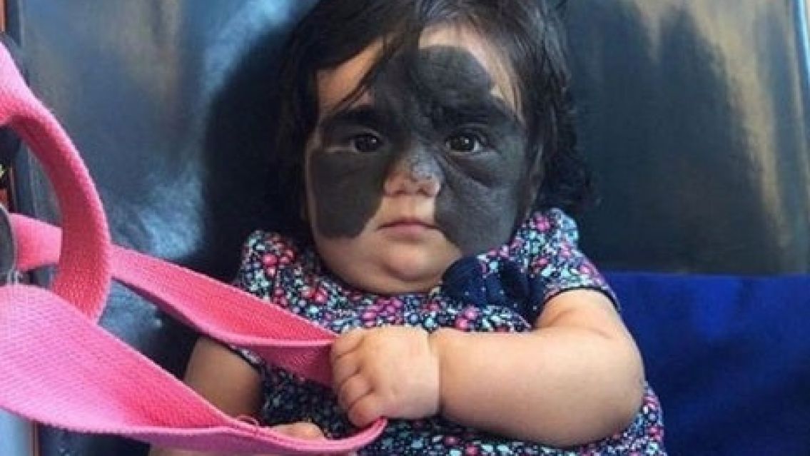 Nació con un lunar gigante en la cara, la operaron y así quedó
