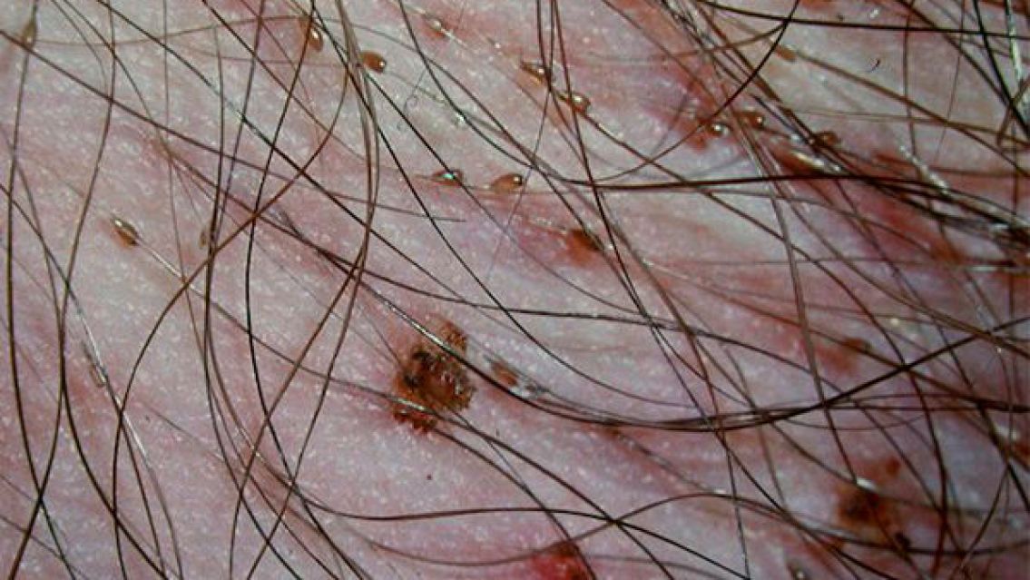 "Piojos púbicos", la enfermedad de transmisión sexual que se propaga en Carnaval