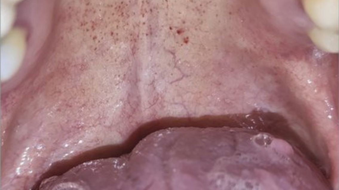 Descubrieron un nuevo síntoma del COVID 19