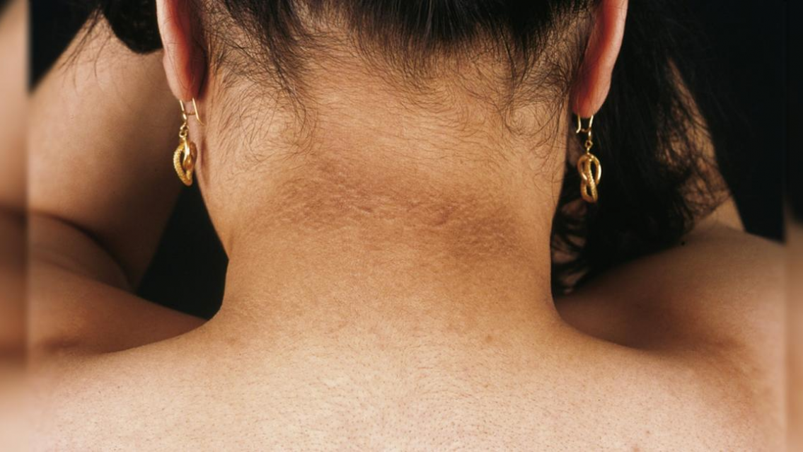 Las peligrosas razones por las que te aparecen las manchas negras en el cuello