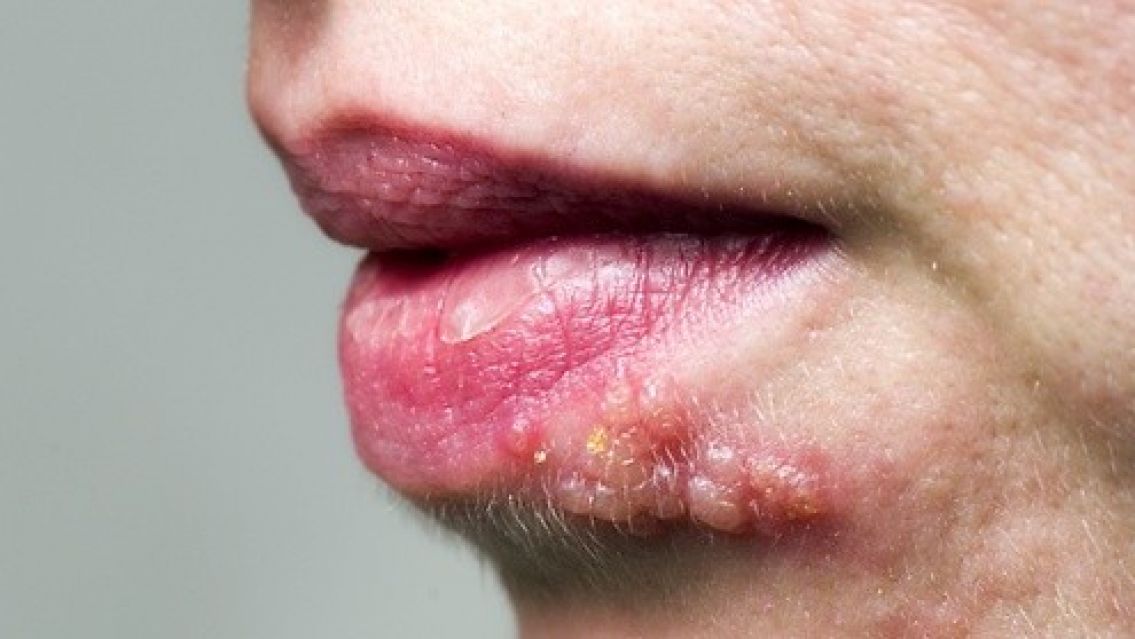 Herpes genital: la enfermedad sexual que pocos conocen y ya muchos la tienen 