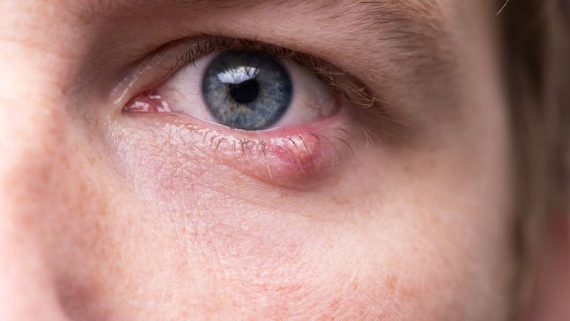 Pensó que tenía conjuntivitis, pero era una enfermedad sexual: así se enteró