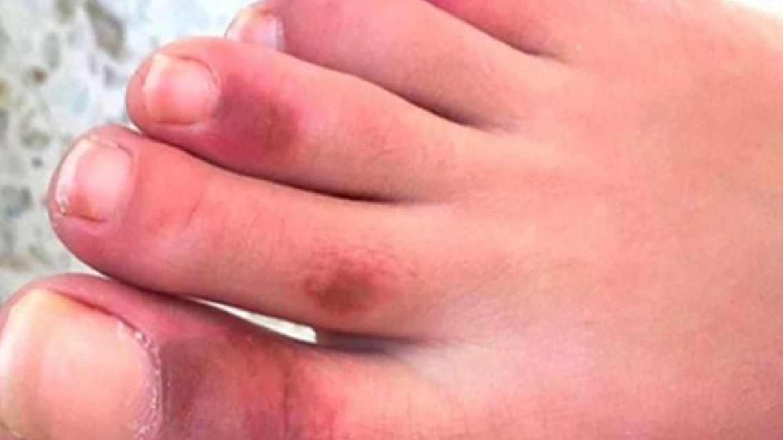 El nuevo s�ntoma de los pies morados que puede durante meses