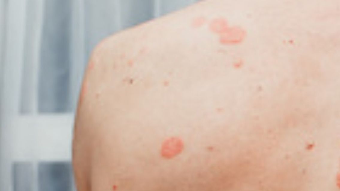 Mancha en la espalda: la enfermedad sexual que pocos conocen y muchos se contagiaron 