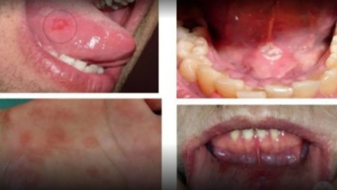 Pensaba que tenía una ampolla en la boca y resultó ser una enfermedad sexual