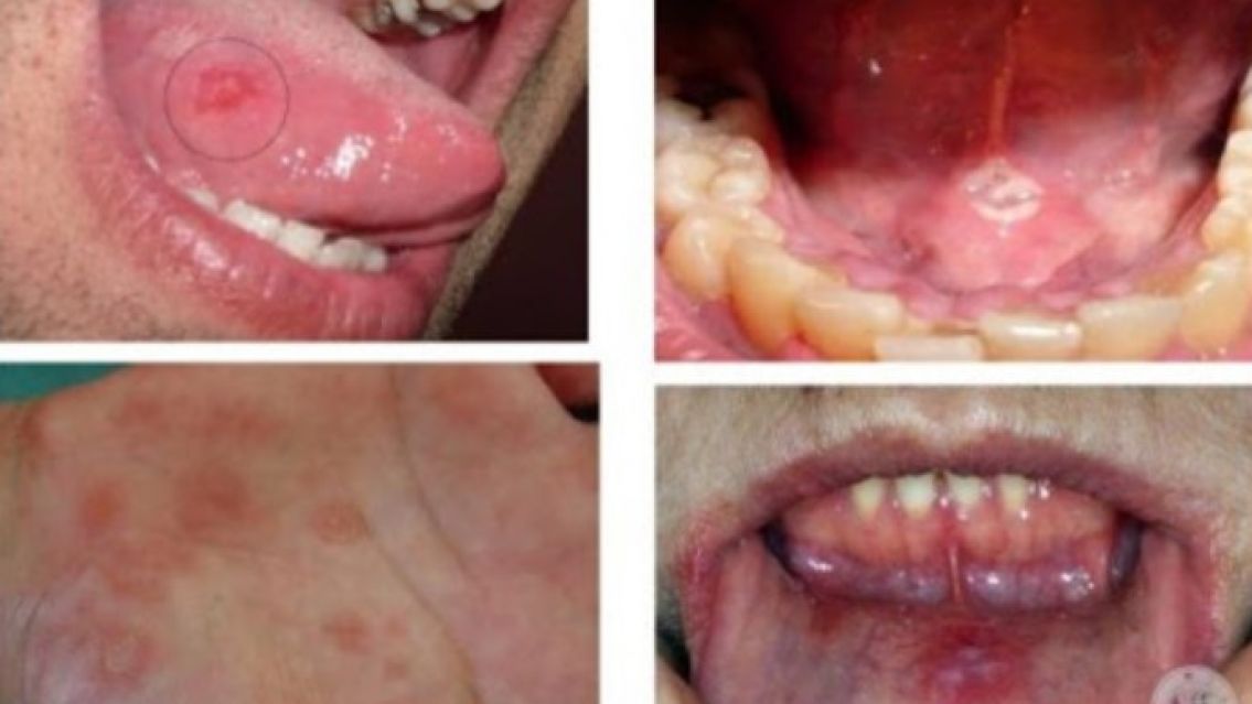 Pensaba que ten�a una ampolla en la boca y result� ser una enfermedad sexual