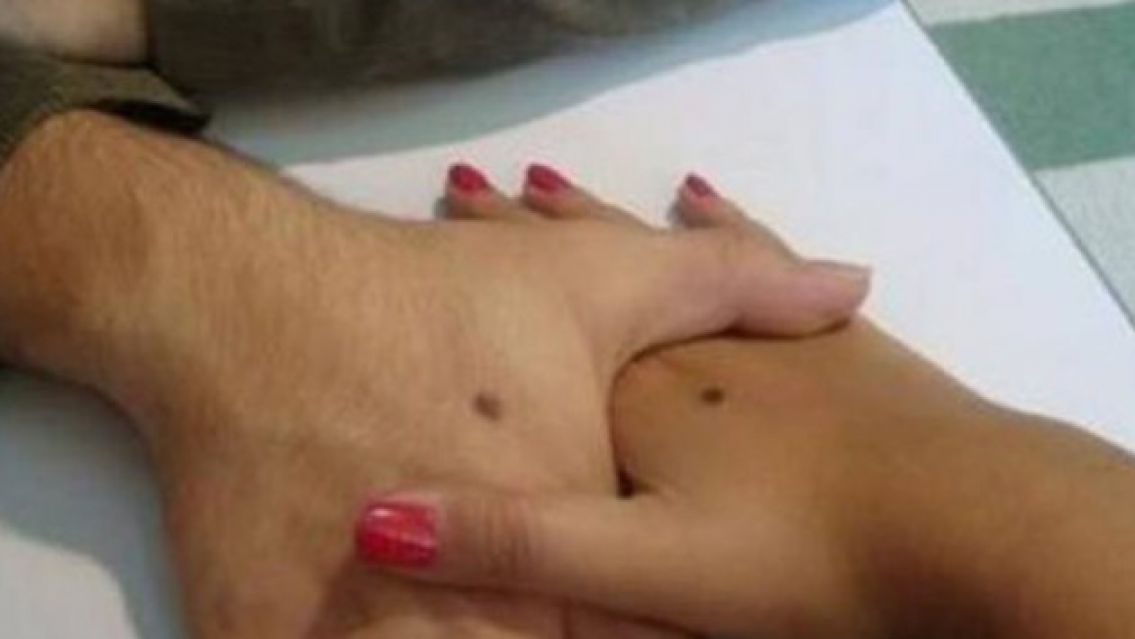 Lunares en la mano: qu� significado tienen seg�n su ubicaci�n