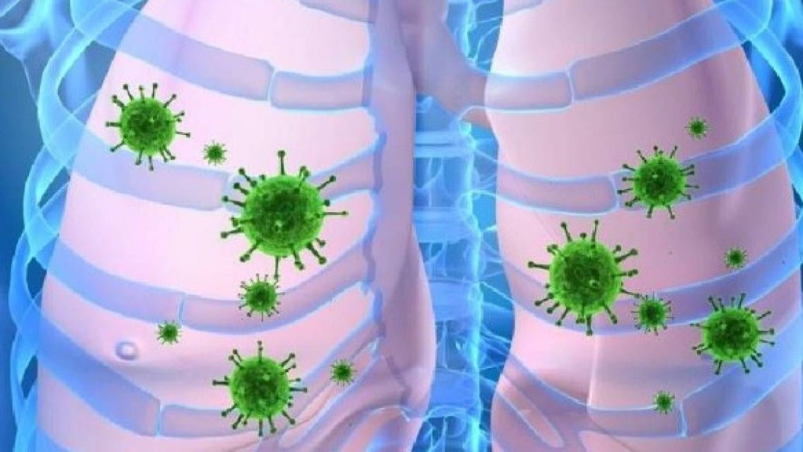 Neumonía bilateral: qué es y cómo afecta al paciente
