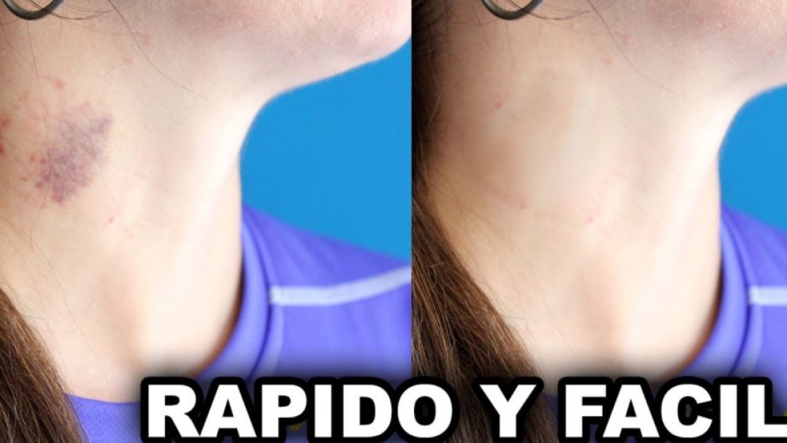 Cómo sacar chupones de forma rápida y sencilla