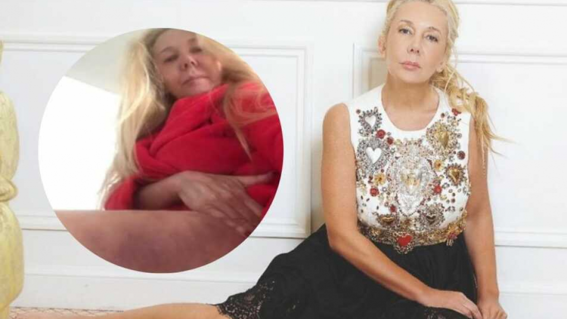 Contó toda la verdad: Mariana Nannis mostró los moretones que le dejó Claudio Paul Caniggia