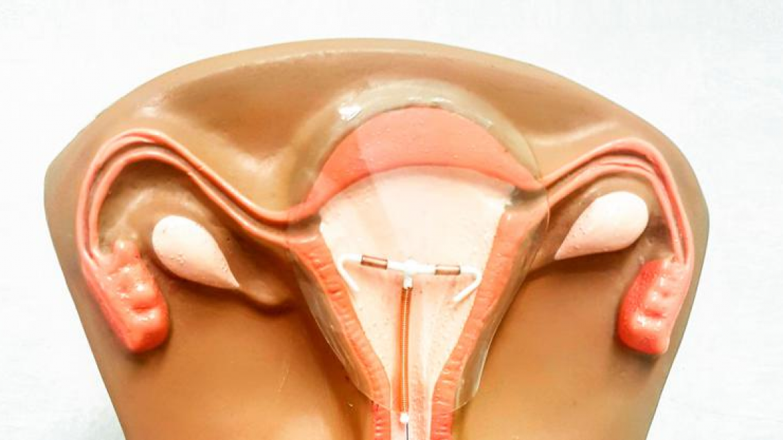 GRATIS: DIU, pastilla "del d�a despu�s", preservativos y m�s. C�mo conseguirlos en Jujuy