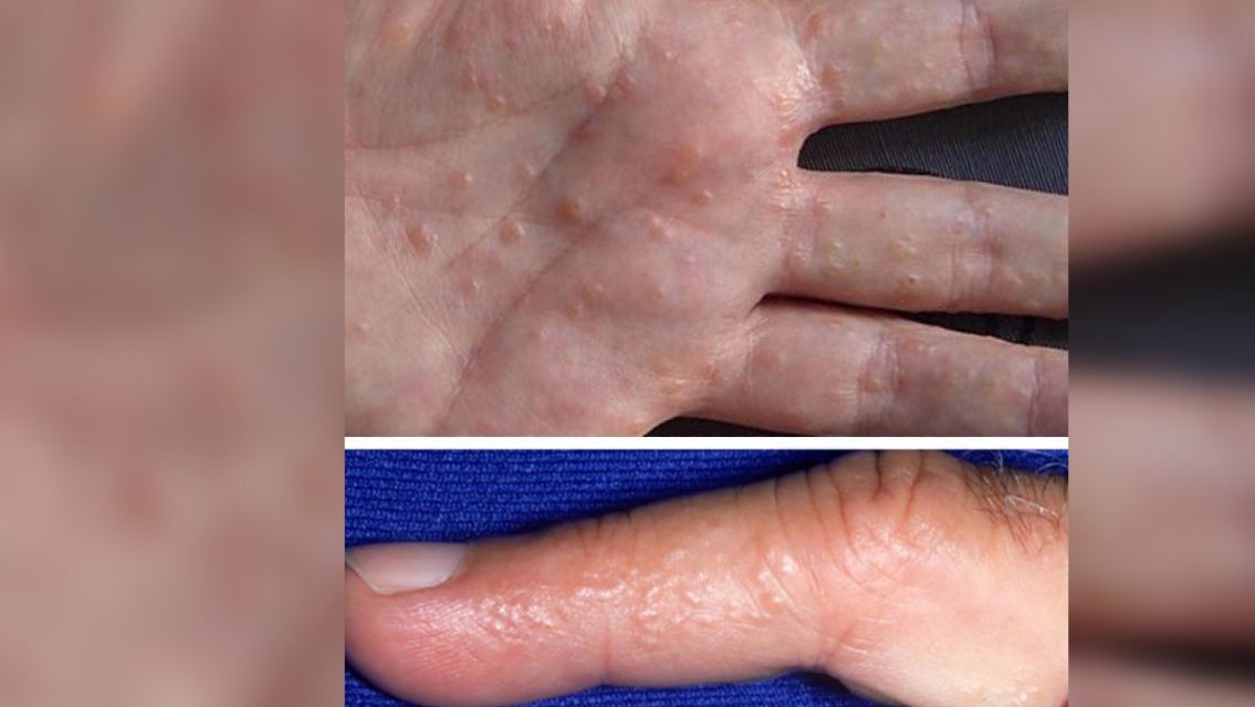 Granitos en las manos: la grave enfermedad que te puede agarrar