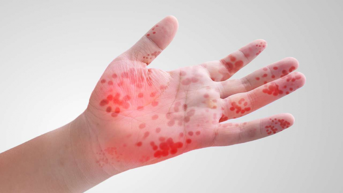 Síndrome de manos-pies-boca, el virus que ataca a los más chicos ahora que hace frío