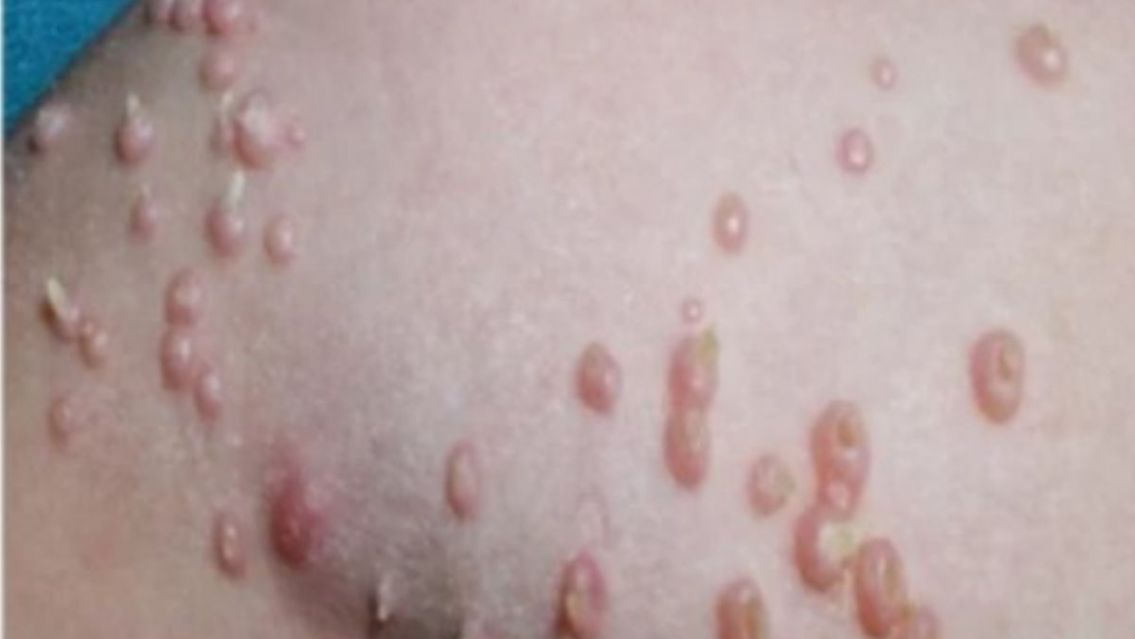 Atenci�n juje�os: la enfermedad sexual que comienza sin s�ntomas y es peligrosa